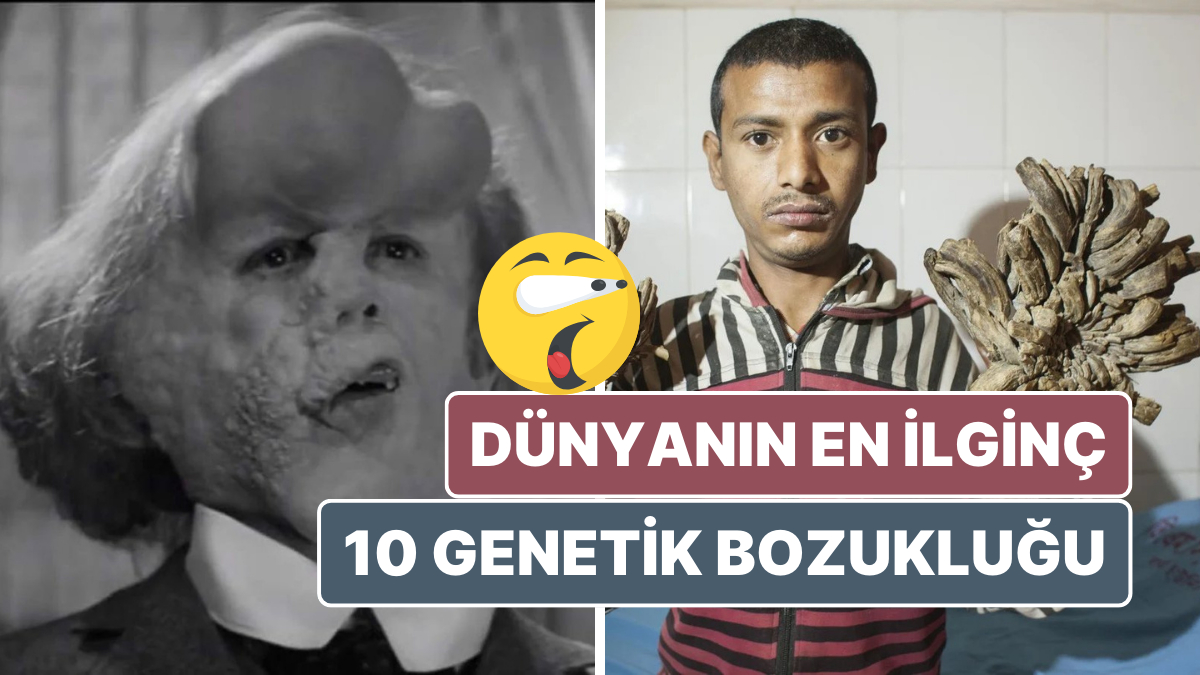 Vampir Hastalığı’ndan Fil Adam Sendromu’na: Dünyanın En İlginç 10 Genetik Bozukluğu